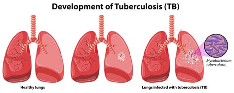 bad tb|About Active Tuberculosis Disease 